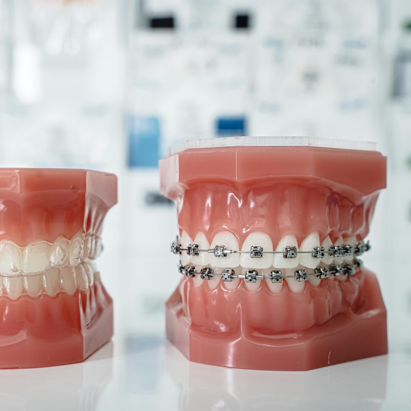 Modèles de dentition avec appareils orthodontiques