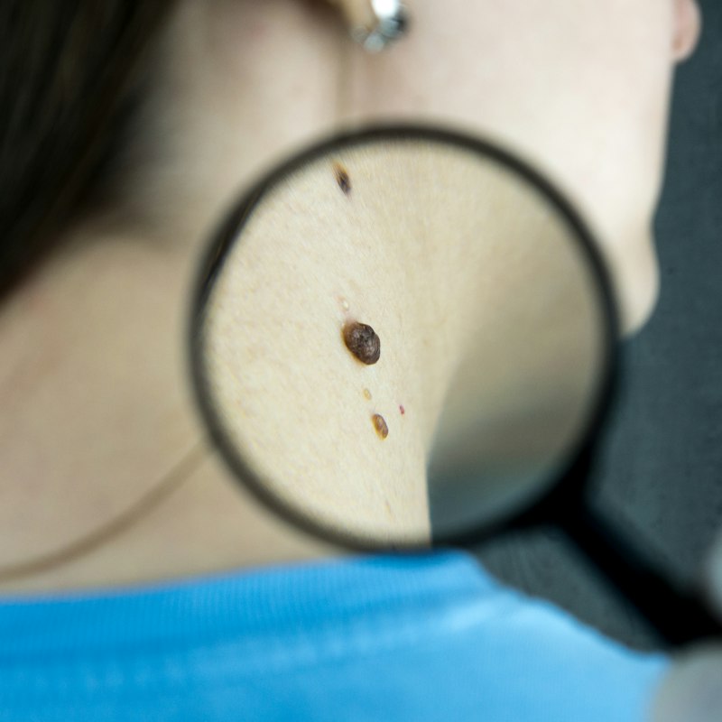 Grain de beauté examiné à la loupe