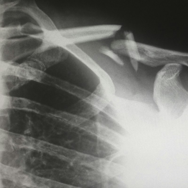 Radiographie d'une épaule et d'une cage thoracique